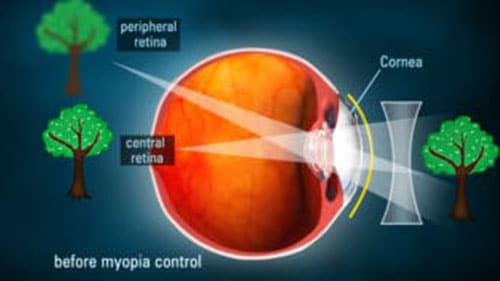 South Bay Specialty Contacts - Myopia Control / Ortho kratology